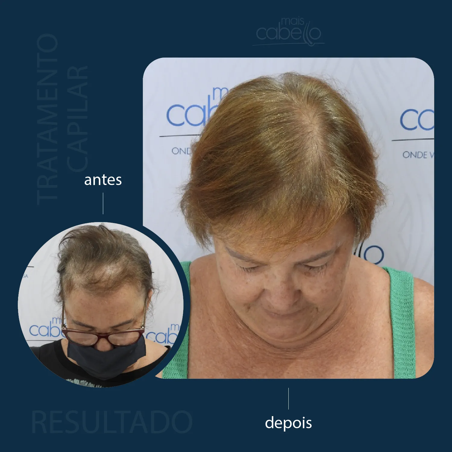 Antes e depois com redução de falhas capilares